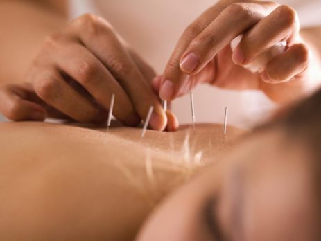 The Benefits of Acupuncture