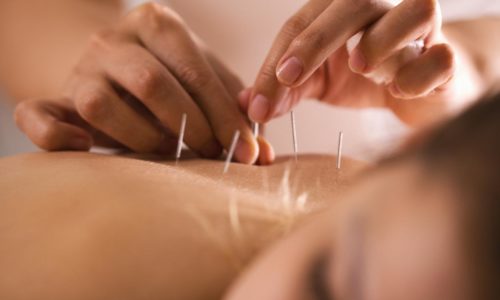 The Benefits of Acupuncture